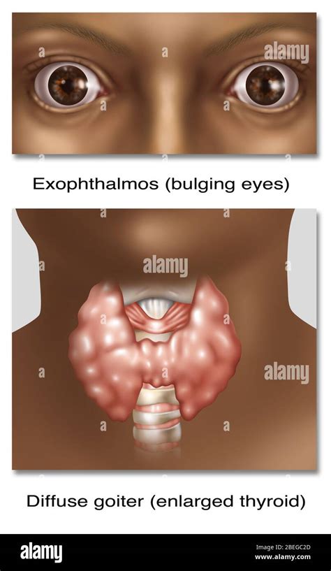 Graves Disease Illustration Stock Photo Alamy