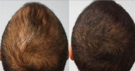 Mesotherapy Treatment For Hair Loss Dr Serkan Aygin Clinic