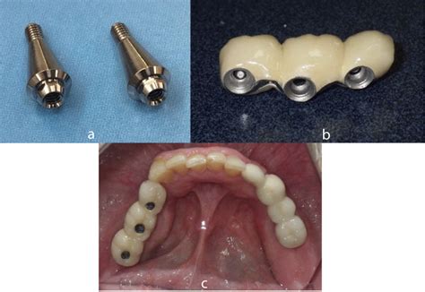 Preventing Peri Implantitis With A Proper Cementation Protocol And With