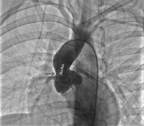 aortography  performed   operation   demonstrated