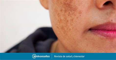 Melasma Causas S Ntomas Y Tratamiento