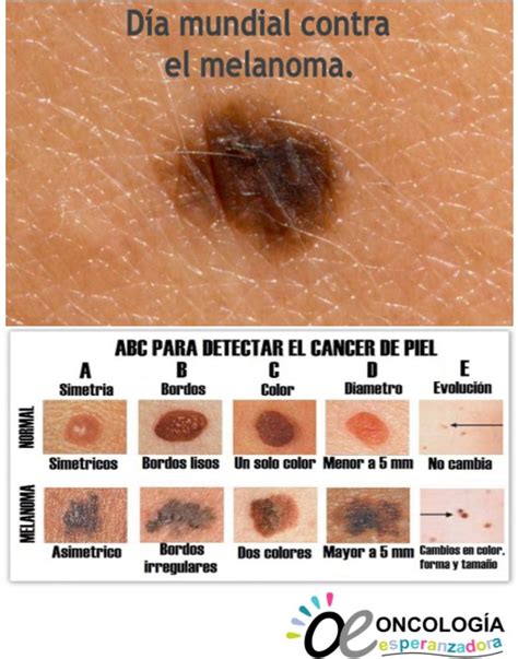 Dia Mundial Del Melanoma