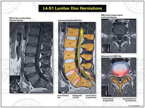 L4-S1 Lumbar Disc Herniations