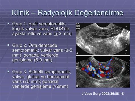 PPT Pelvik Venöz Konjesyon Sendromu PowerPoint Presentation free