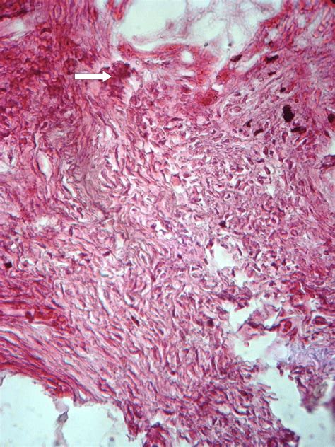 Test Specimen Group II After One Month Mature Fibrous Tissue With
