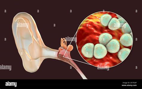 Tympanic Membrane Otitis Media Hi Res Stock Photography And Images Alamy