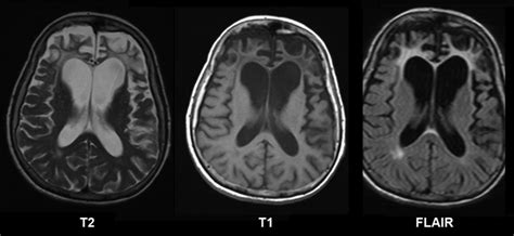 Atrofia Cerebral Caracter Sticas S Ntomas Y Causas