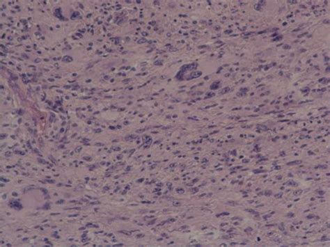 Spindle Cell Proliferation Arranged In Interlacing Fascicles ×100