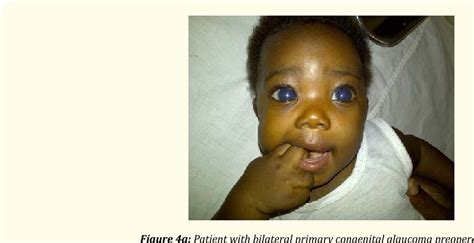 Congenital Glaucoma