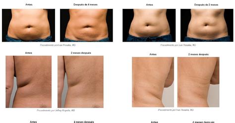 Criolipolisis Qu Es Cryolipolysis Comentarios Informaci N Y Resultados