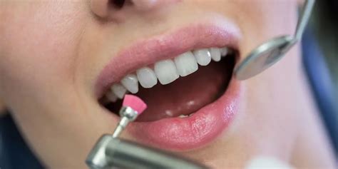 The Importance of Scaling and Polishing | White Perfect Dental