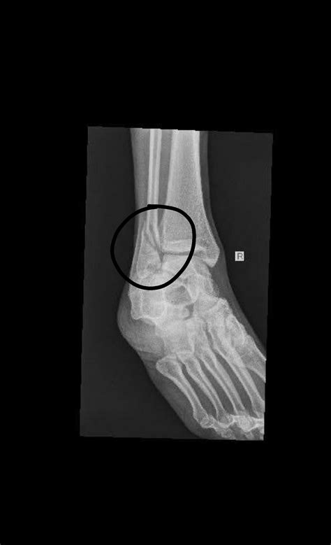 Do I Really Need Surgery? I had my first 2 doctor's tell me no, but the