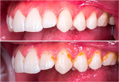 Inflamación De Encías Causas Y Tratamientos Dental Roca