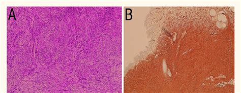 Histopathologic Findings Of The Left Breast Lesion In A 35 Year Old