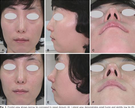 Figure From Diagnosis And Treatment Of Dynamic External Nasal Valve