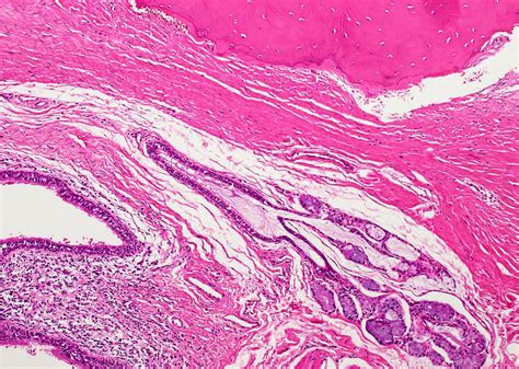 Thyroglossal Duct Cyst Histology