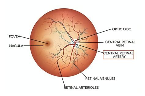 Central Retinal Artery Occlusion Symptoms Causes Diagnosis Prevention Goyal Eye