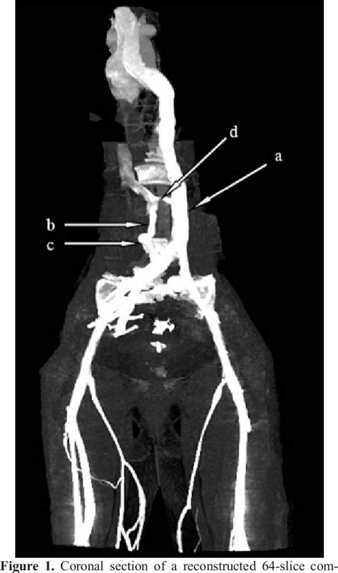 Figure 1 From Dual Inferior Venae Cavae With Mitral Stenosis Semantic