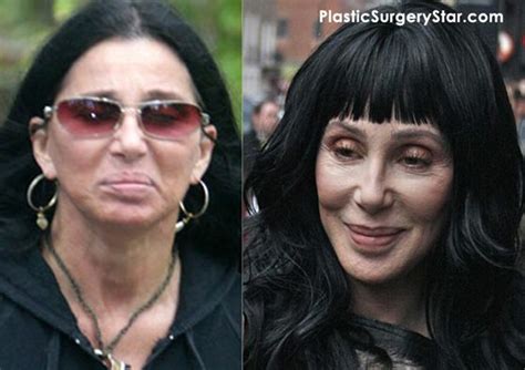 Cher Gets Plastic Surgery For A Facelift Cher Plastic Surgery