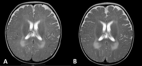 Axial T2 Weighted Brain Magnetic Resonance Images Of The Patient At 6