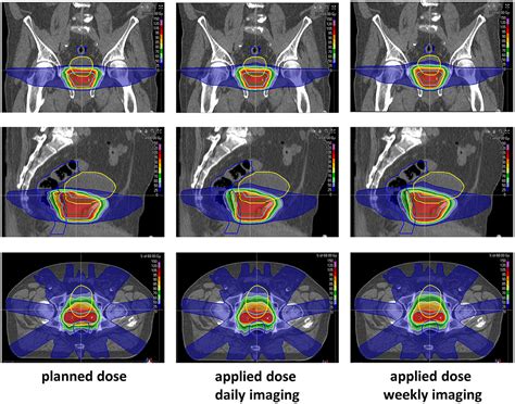 Frontiers Dosimetric Impact Of Interfractional Variations For Post