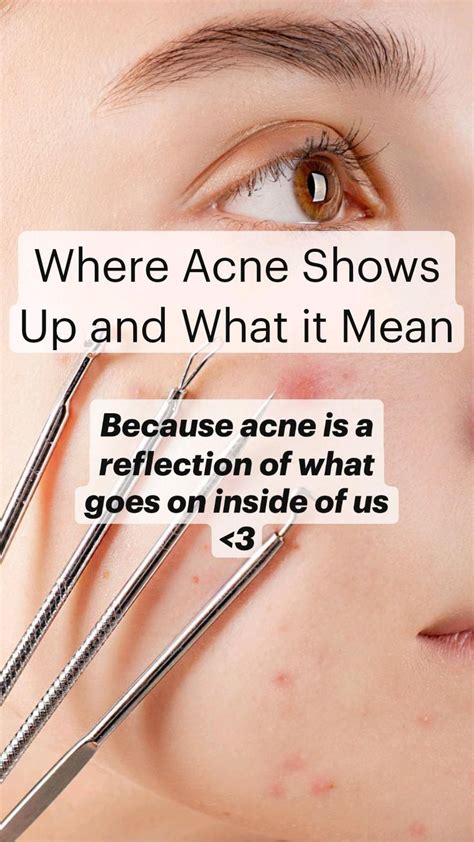 Where Acne Shows Up And What It Mean • Skin Care • Acne Placement • Acne Meaning • Holistic