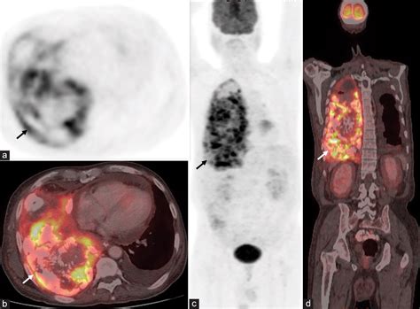 Primary Pulmonary Osteosarcoma A Rare Malignancy Of The Lung With