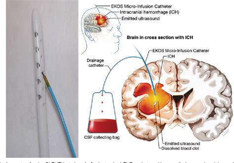 Brain Hemorrhage Diagram