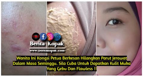 Cara Hilangkan Parut Jerawat Berlubang Blog Norliza Osman Suami Cari