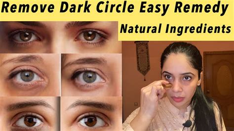 How To Remove Dark Circle Naturally 🌿in Few Day Easy To Apply