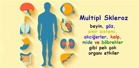 Multipl Skleroz Ms Hastal Neden Olur Belirtileri Ve Tedavisi