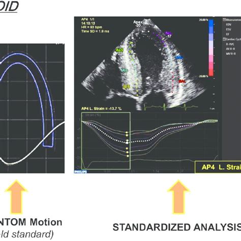 Pdf Speckle Tracking Imaging Principles And Clinical Applications A