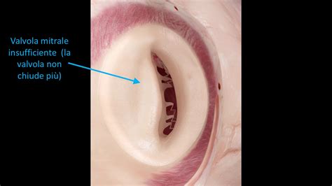 Valvulopatia Mitralica Fondazione Cuore Domani Sicch