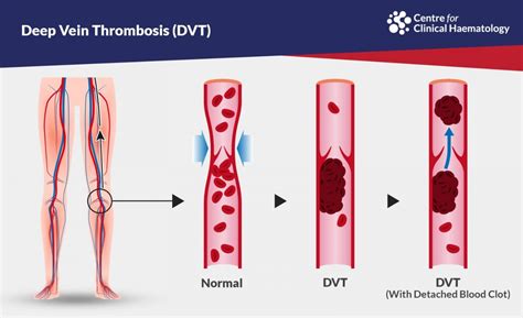 Deep Vein Thrombosis (DVT) | CFCH | Centre for Clinical Haematology