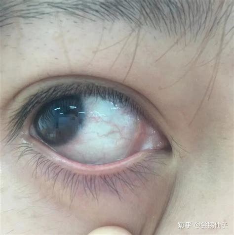 眼睛干涩、肿痛、红血丝、看东西模糊怎么办？大家有哪些保护眼睛的办法？ 知乎