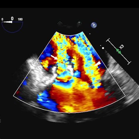 Pdf Acute Infective Endocarditis Masquerading As Septic Shock With Acute Respiratory Distress