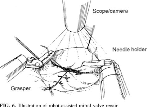 Figure 6 From The Evolution Of And Early Experience With Robot Assisted