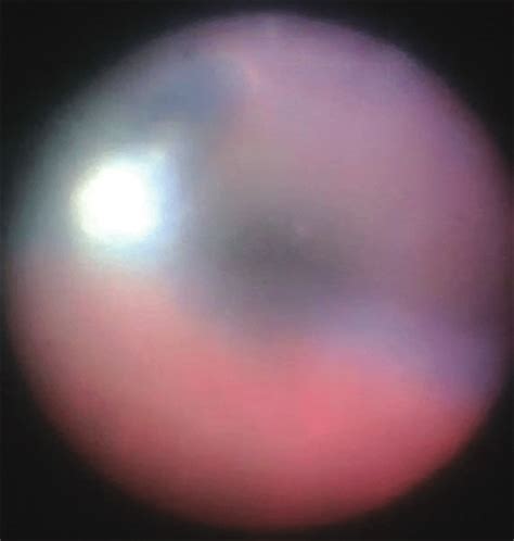 Intraoperative Endoscopic Findings With A 23 Gauge Cannula Inserted