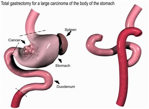 Total Gastrectomy