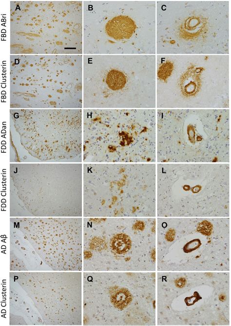 Immunohistochemical Identification Of Clusterin And Corresponding