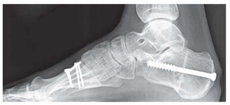 Augmented Lateral Ankle Ligament Reconstruction for Persistent Ankle Instability ...