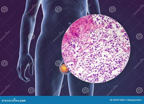 Testicular Cancer Testicular Seminoma Medical 3d Illustration And