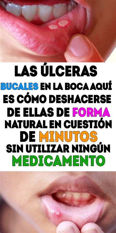 Las úlceras bucales en la boca aquí es cómo deshacerse de ellas de