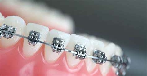 Orthodontics Australia How Are Metal And Ceramic Braces Different