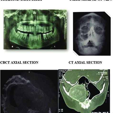 Orthopantamogram Showing Mixed Radiolucent Radiopaque Lesion In The