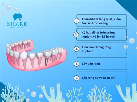 Quy Tr Nh Tr Ng R Ng Implant Chu N Y Khoa T I Shark Dental Nha Khoa Shark