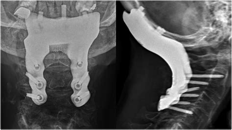 Patient Specific Processes For Occipitocervical Fixation Using