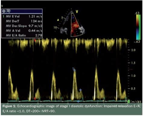 Diastolic Dysfunction and Diastolic Heart Failure: Part One - Pathophysiology