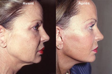 Lifting Cervico Facial Tout Savoir Sur Cette Op Ration