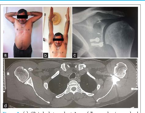 Figure 2 From Bilateral Coracoid Avulsion Fractures With Unilateral